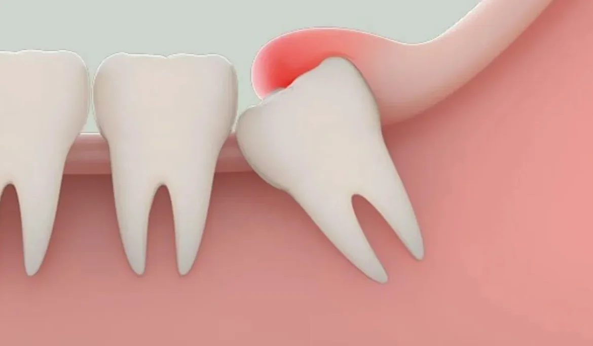 khi nào không nên nhổ răng khôn