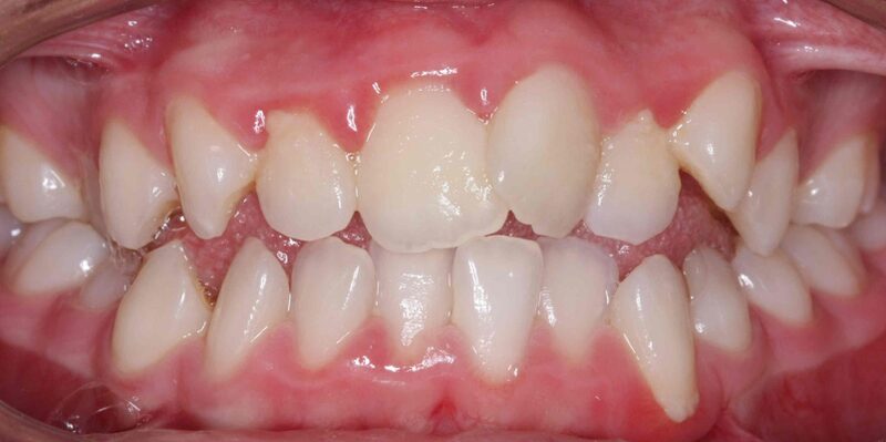 răng mọc lộn xộn