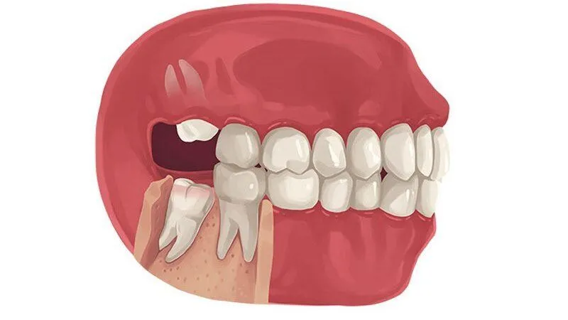 nhổ răng hàm có ảnh hưởng đến thần kinh không