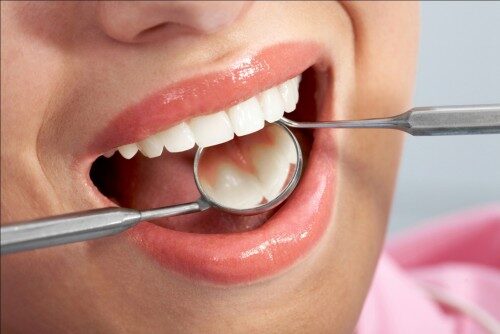 trám răng ở Hải Phòng