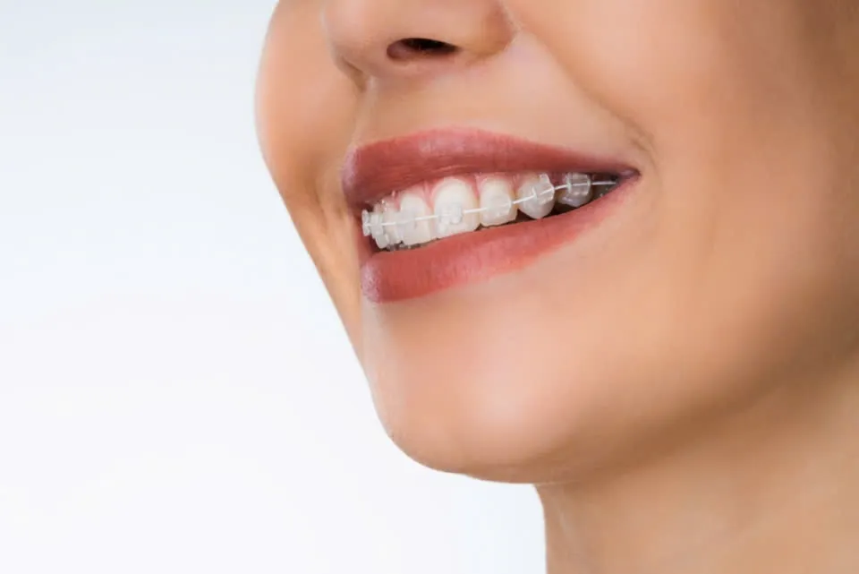 có nên niềng răng mắc cài pha lê không