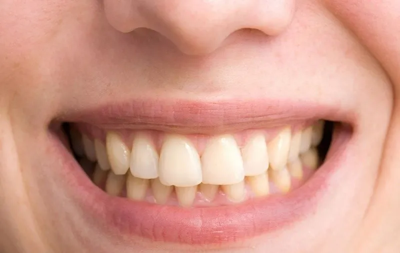 Có thể tự tẩy trắng răng ố vàng tại nhà không
