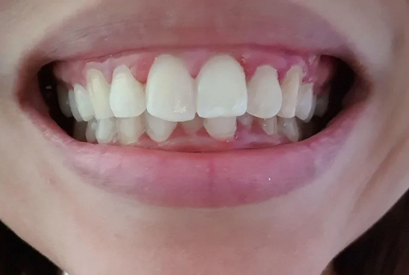 Các khuyết điểm phổ biến ở 2 răng cửa