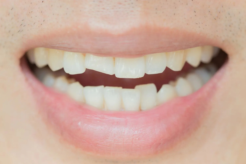 Các nguyên nhân dẫn đến răng bị mẻ