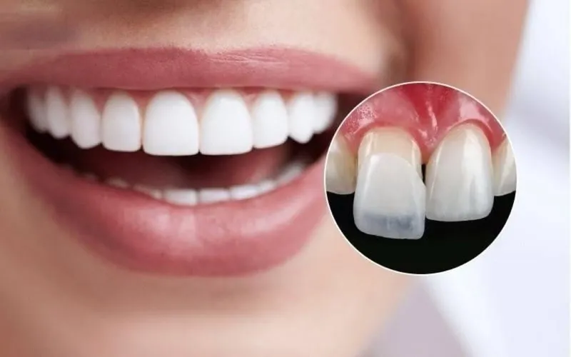 So sánh dán sứ Veneer và bọc răng sứ