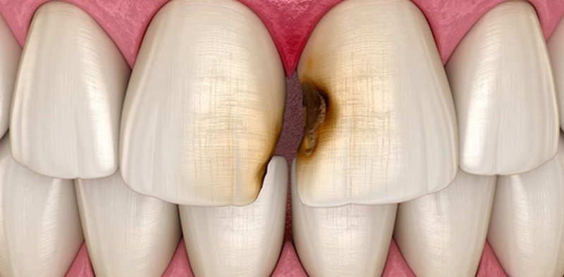 Các giai đoạn khi bị sâu kẽ răng