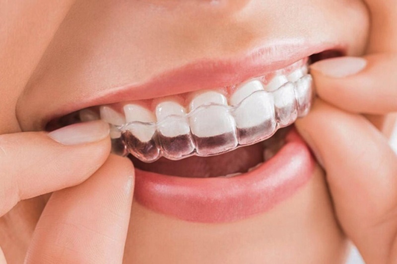 Bộ niềng răng tại nhà cho người lớn
