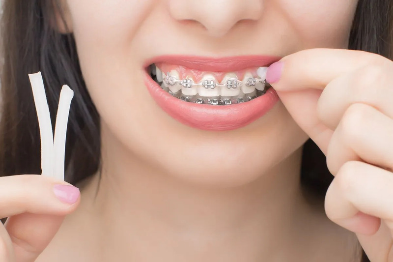 Sử dụng sáp nha khoa cho người niềng răng