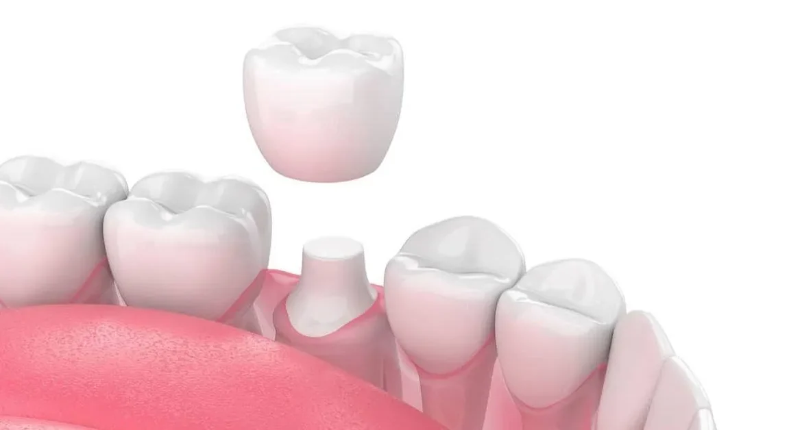 bọc răng sứ có phải mài răng không