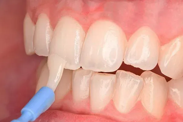 răng có mảng bám ố vàng