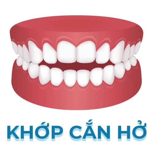 khớp cắn hở