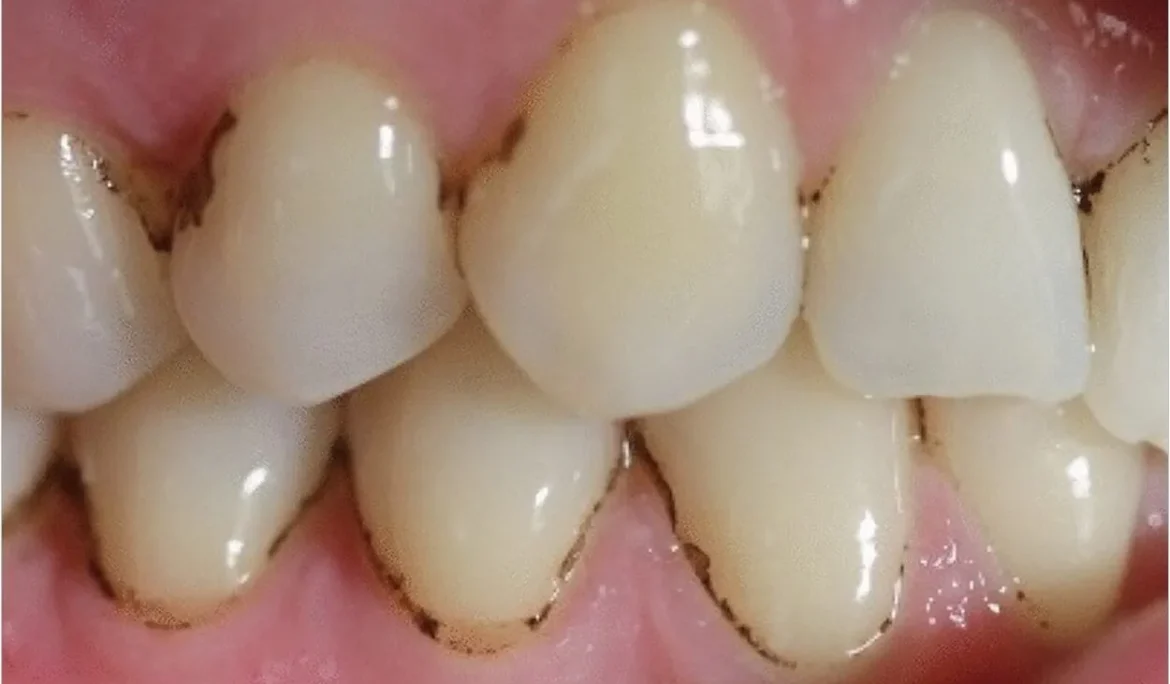 các mảng bám đen trên răng