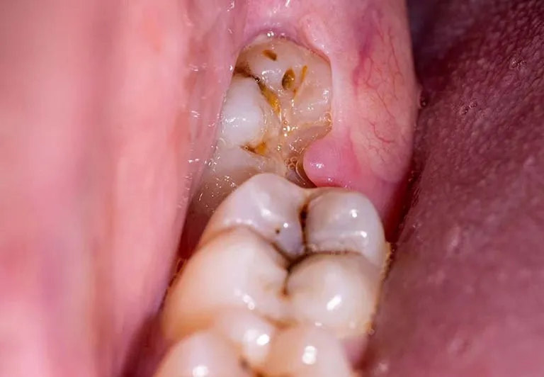 cách chữa đau răng số 8