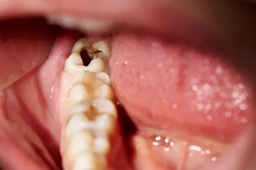 bị sâu răng có nên nhổ không