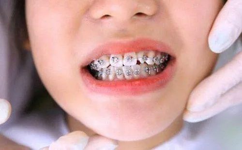 khuyến mãi niềng răng