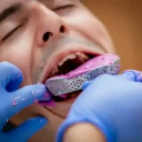 lấy dấu răng có đau không