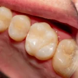 mọc răng cấm hàm dưới