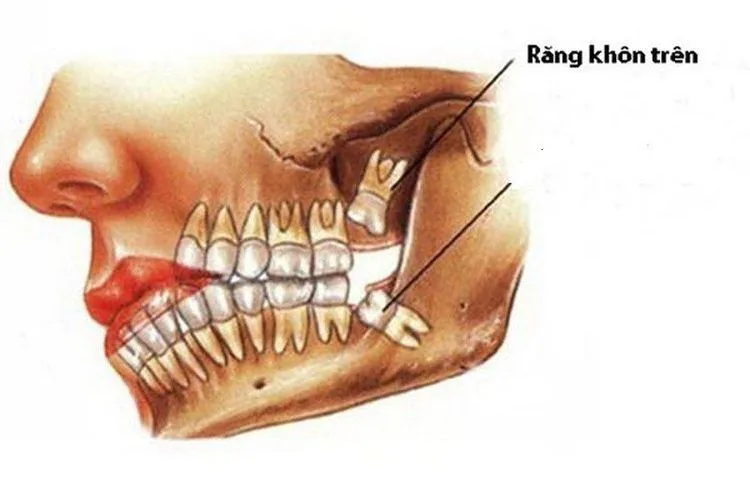 mọc răng hàm trên trong cùng